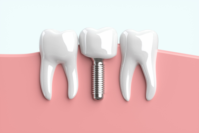 インプラント治療のメリットとデメリット